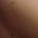 Gevaarlijke moedervlek: herkennen van huidkanker