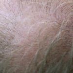 Haarverlies bij de haargrens: kale plekken door haaruitval