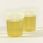Stinkende urine: vieze stank bij plassen