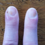 Ontstoken vinger of teen: pijnlijk, dik en rood