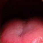 Pijn in de tong; wat kunnen de oorzaken zijn?